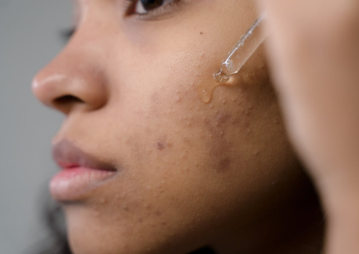 Close-up of person applying facial oil with dropper to skin showing scars and hyperpigmentation
