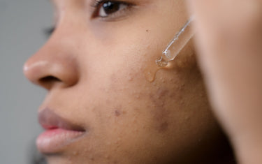 How to Use Tea Tree Oil for Acne