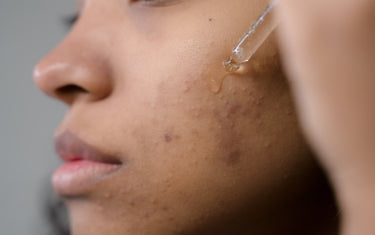 Woman applying oils to acne scars